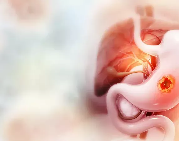 Ästhetische KI-Darstellung eines Magens mit Tumor