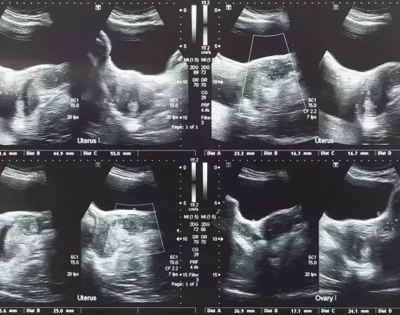 Ultraschallbilder von Tumor oder Leiomyom, unteres Abdomen.